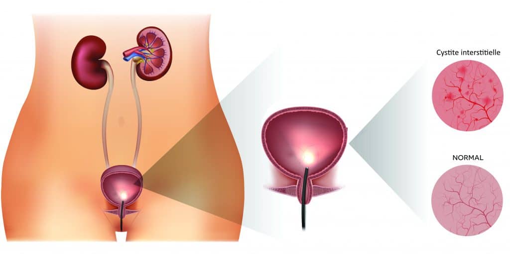 cystite interstitielle infographie